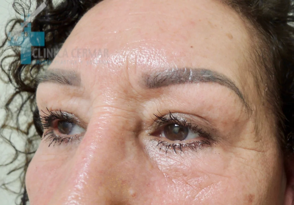 BLEFAROPLASTIA SUPERIOR - DESPUES