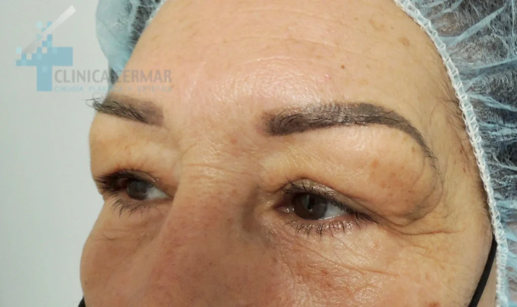 BLEFAROPLASTIASUPERIOR - ANTES