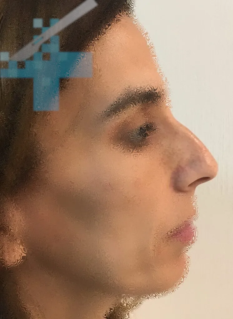 Rinoplastia en Sevilla 5 Antes