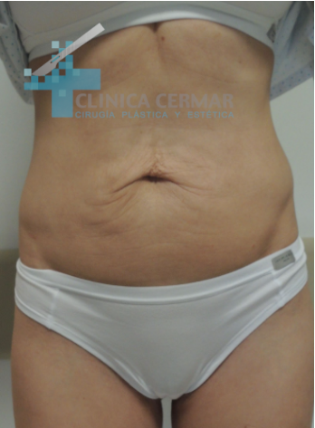 abdominoplastia-en-sevilla-antes-2