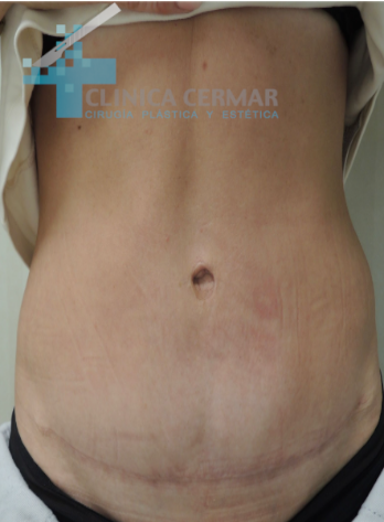 abdominoplastia-en-sevilla-despues-2