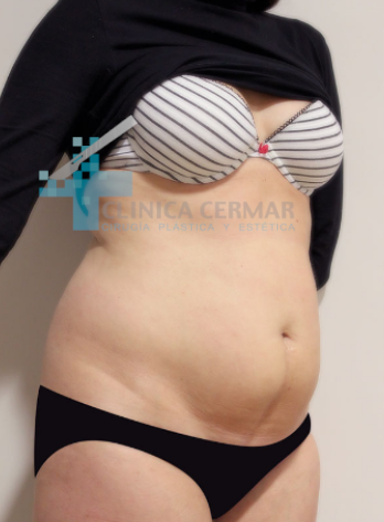 abdominoplastia-en-sevilla_-antes-1
