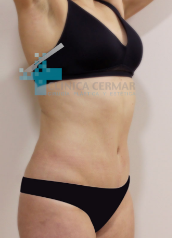 abdominoplastia-en-sevilla_-antes-2