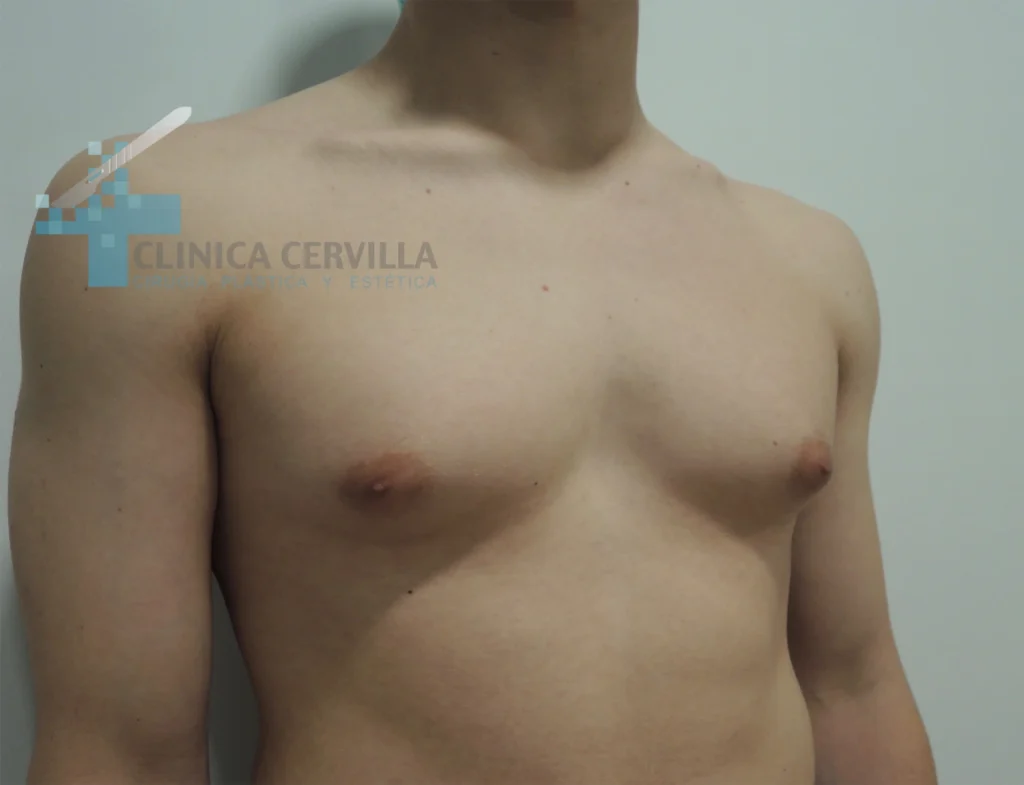 abdominoplastia sevilla -antes (1)