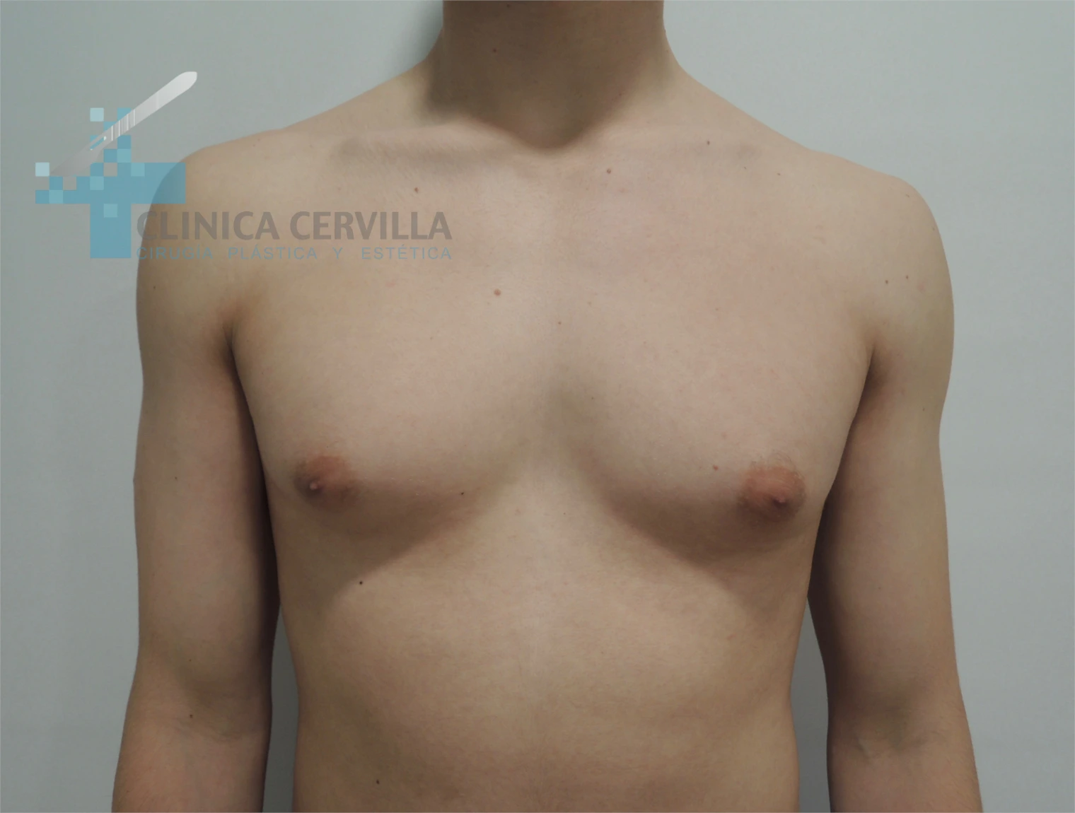 abdominoplastia sevilla -antes (2)