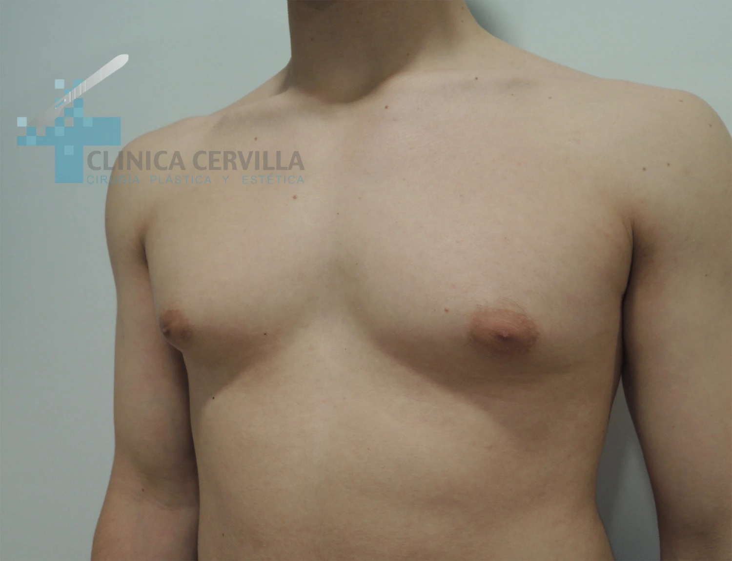 abdominoplastia sevilla -antes (3)