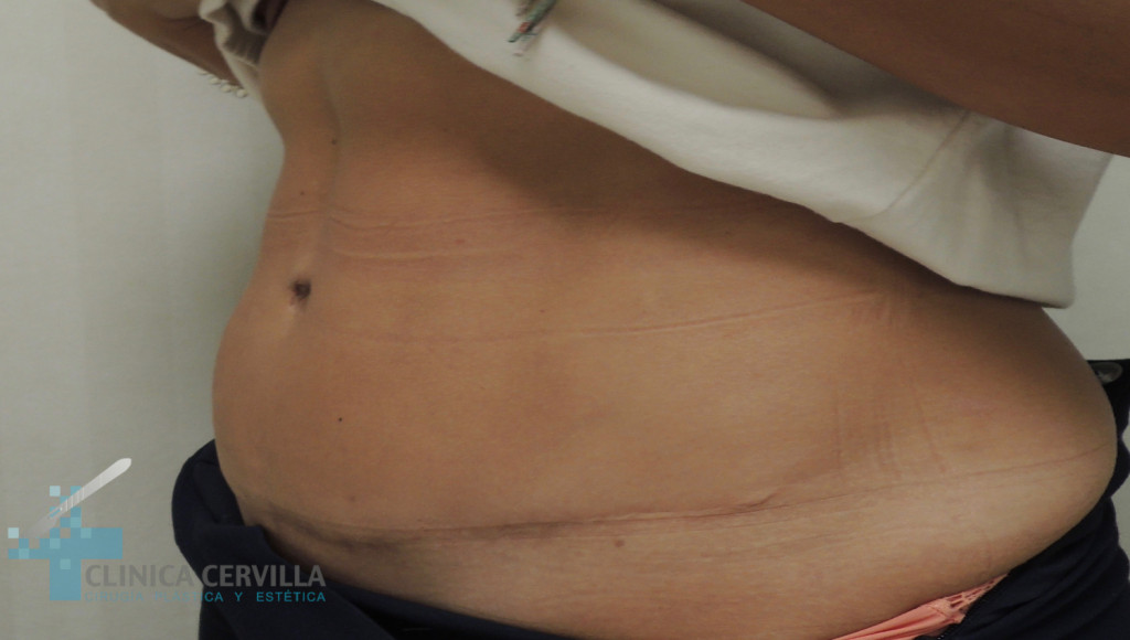 abdominoplastia-sevilla-antes-_2_