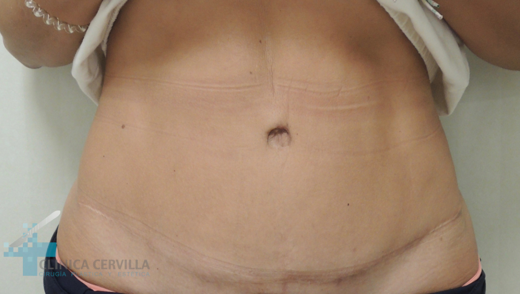 abdominoplastia-sevilla-antes-_3_