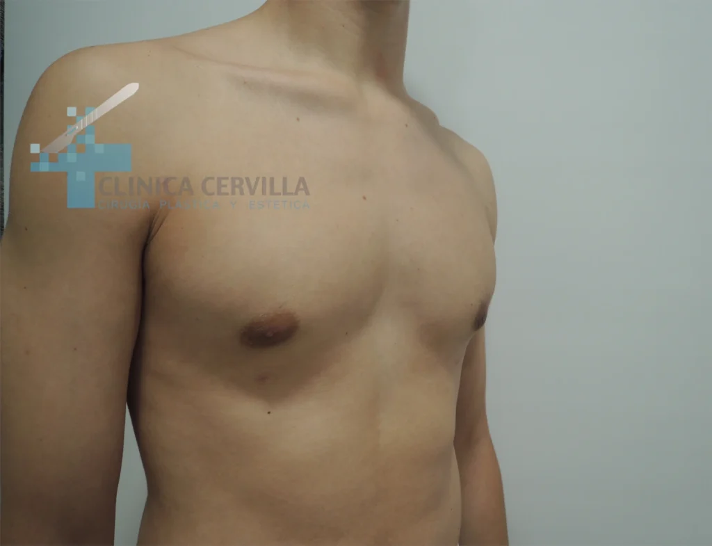 abdominoplastia sevilla - despues (1)