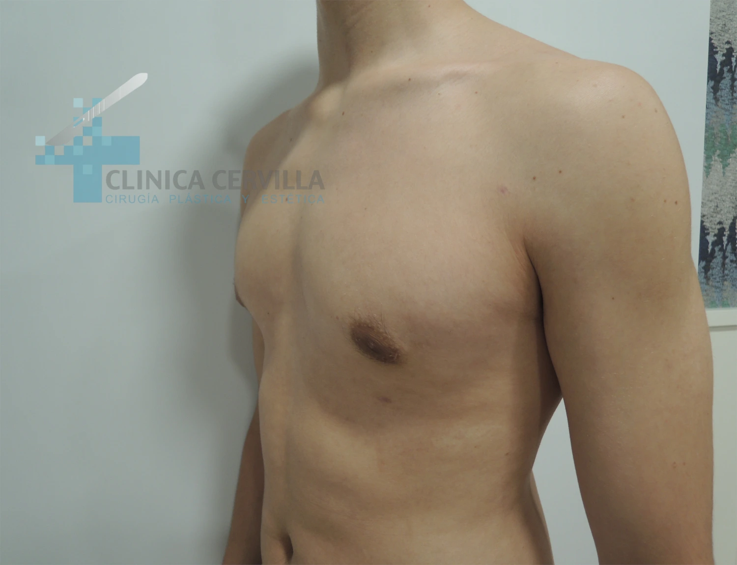 abdominoplastia sevilla - despues (2)
