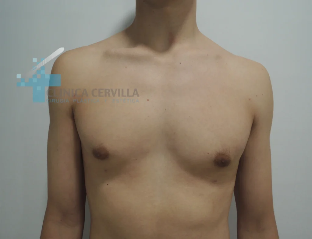 abdominoplastia sevilla - despues (3)