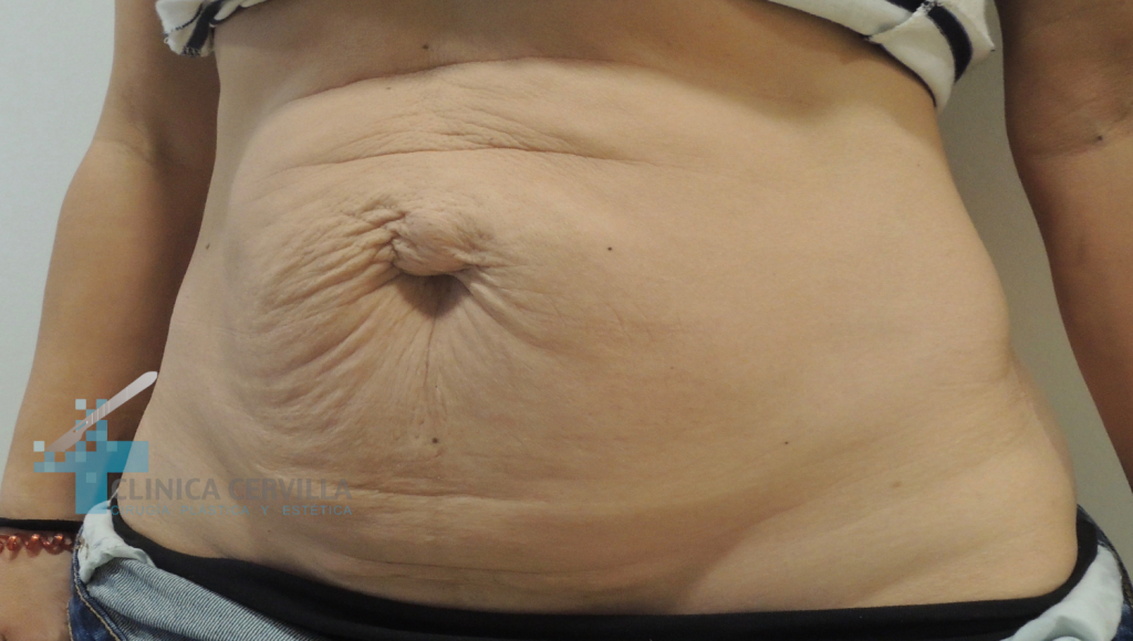 abdominoplastia-sevilla-despues-_1_