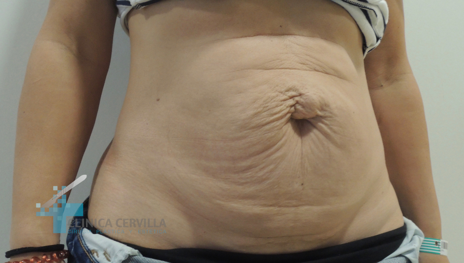 abdominoplastia-sevilla-despues-_2_