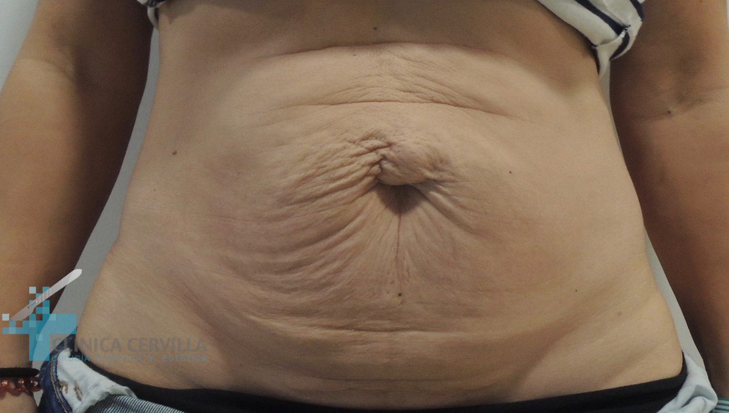 abdominoplastia-sevilla-despues-_3_