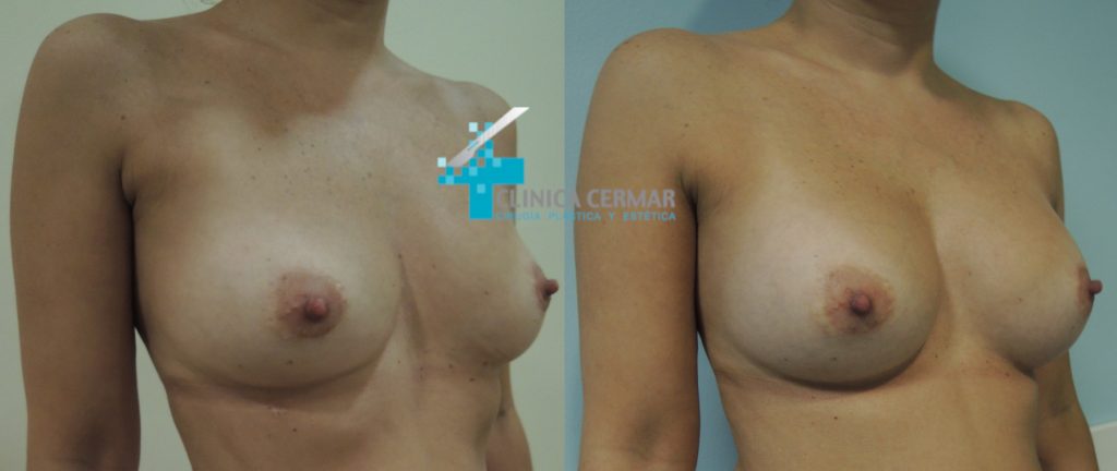 antes despues explanacion mamas 2