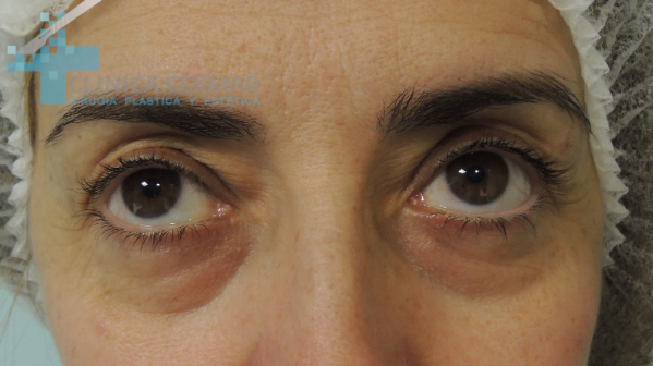 blefaroplastia inferior sevilla antes 1