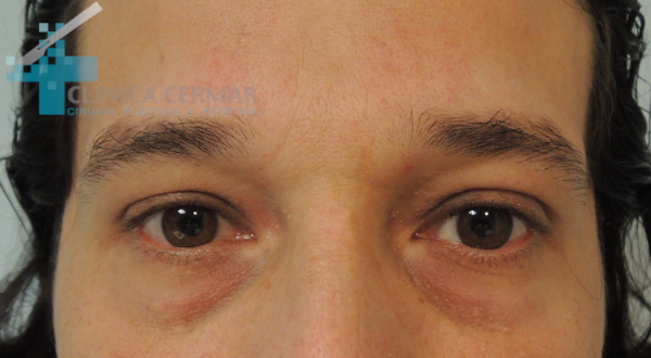 blefaroplastia inferior sevilla antes 2