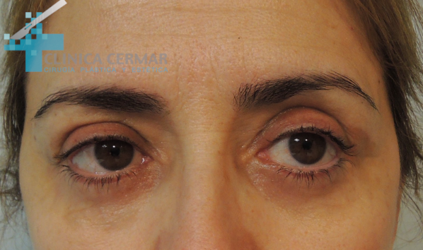 blefaroplastia inferior sevilla despues 1