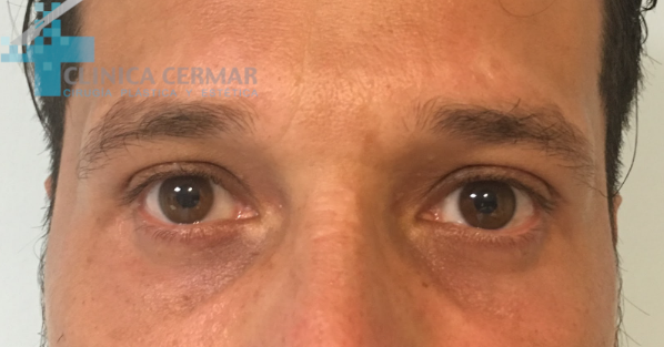 blefaroplastia inferior sevilla despues 2