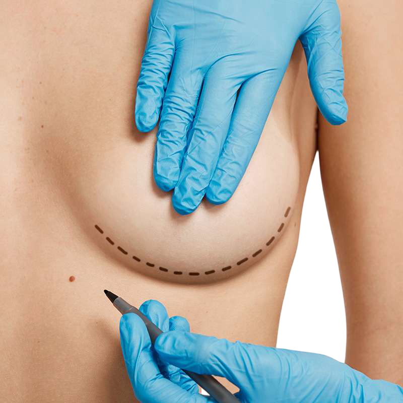 cambio-implantes-mamarios-misma-cicatriz