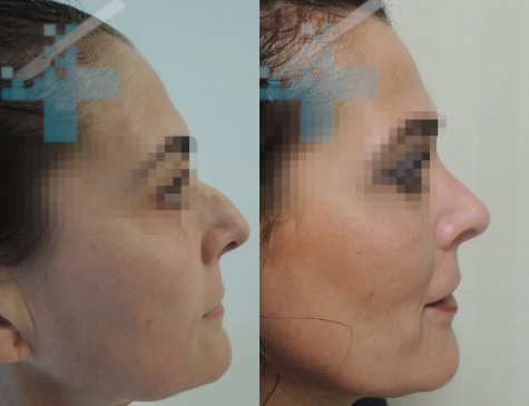 caso-rinoseptoplastia-giba-en-el-dorso-nasal