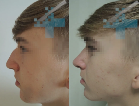 caso-rinoseptoplastia-giba-nasal-y-punta-caida-nino