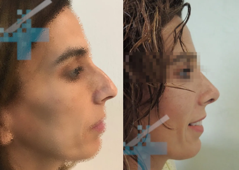 caso-rinoseptoplastia-giba-nasal-y-punta-caida