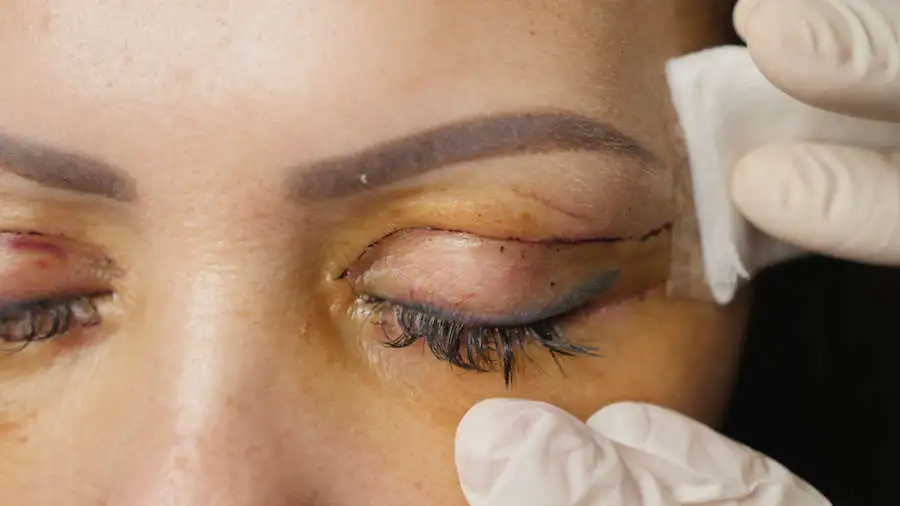cicatriz-blefaroplastia