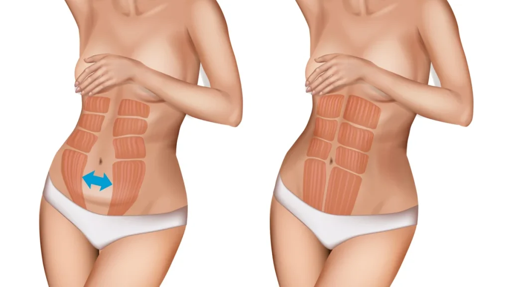 diastasis abdominal posparto