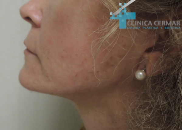 lifting-facial-despues