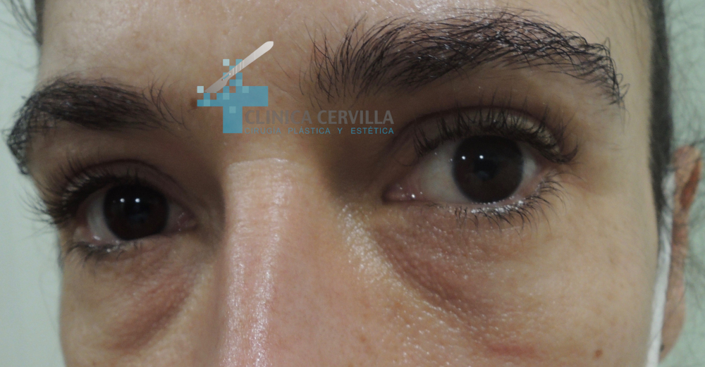 ojeras-acido-hialuronico-antes-1