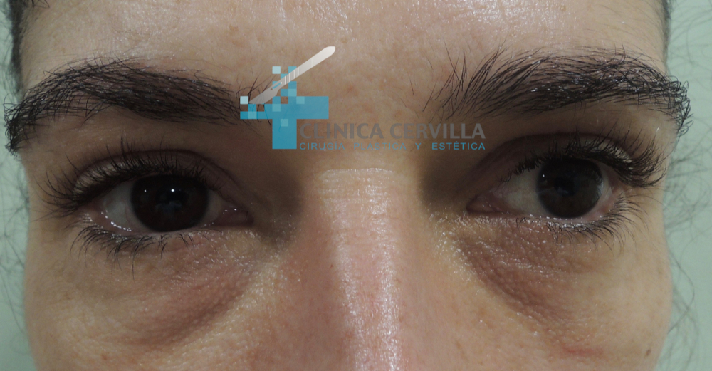 ojeras-acido-hialuronico-antes-2
