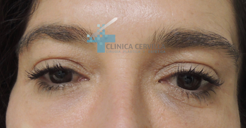ojeras-acido-hialuronico-despues-1