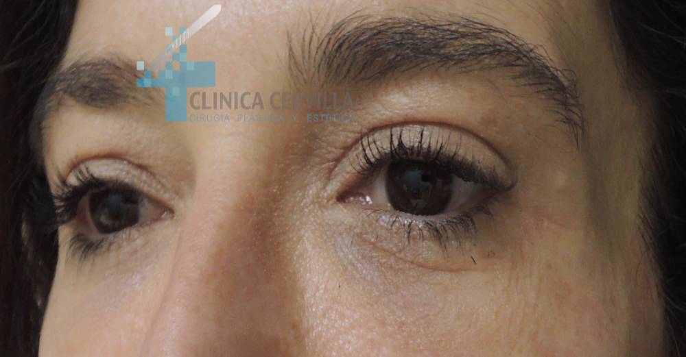 ojeras-acido-hialuronico-despues-2