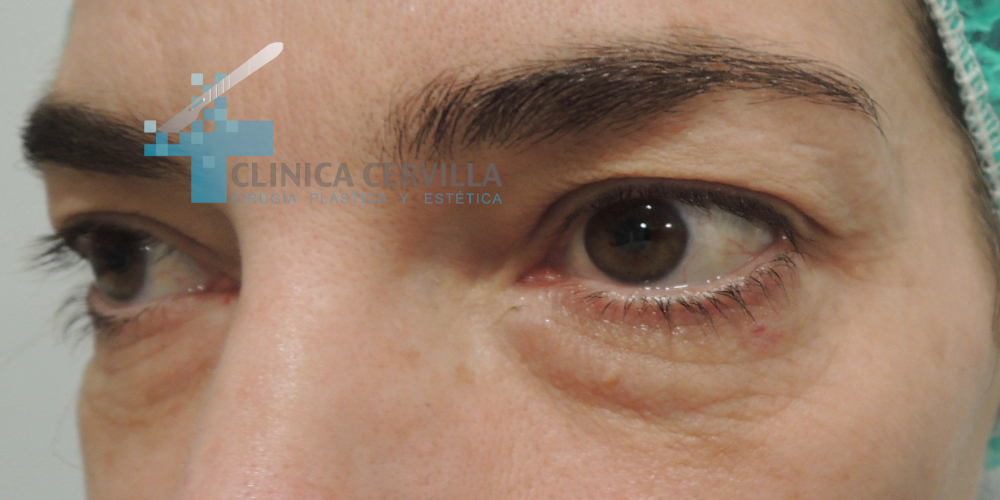 ojeras con blefaroplastia 1- antes