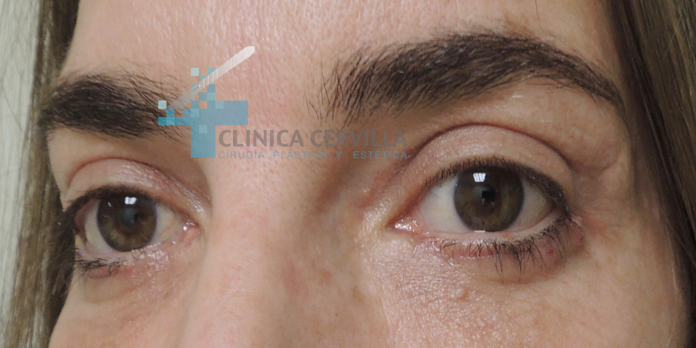 ojeras con blefaroplastia 1- despues