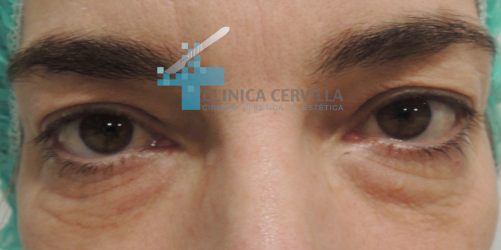 ojeras con blefaroplastia 2- antes