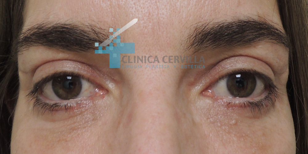 ojeras con blefaroplastia 2- despues