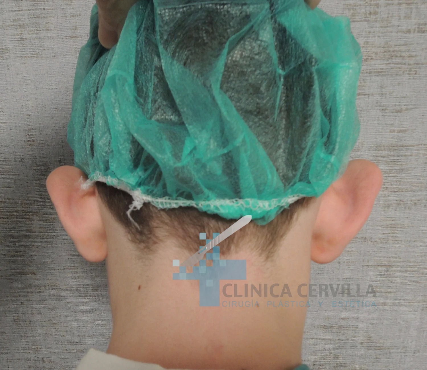 otoplastia sevilla - antes 1