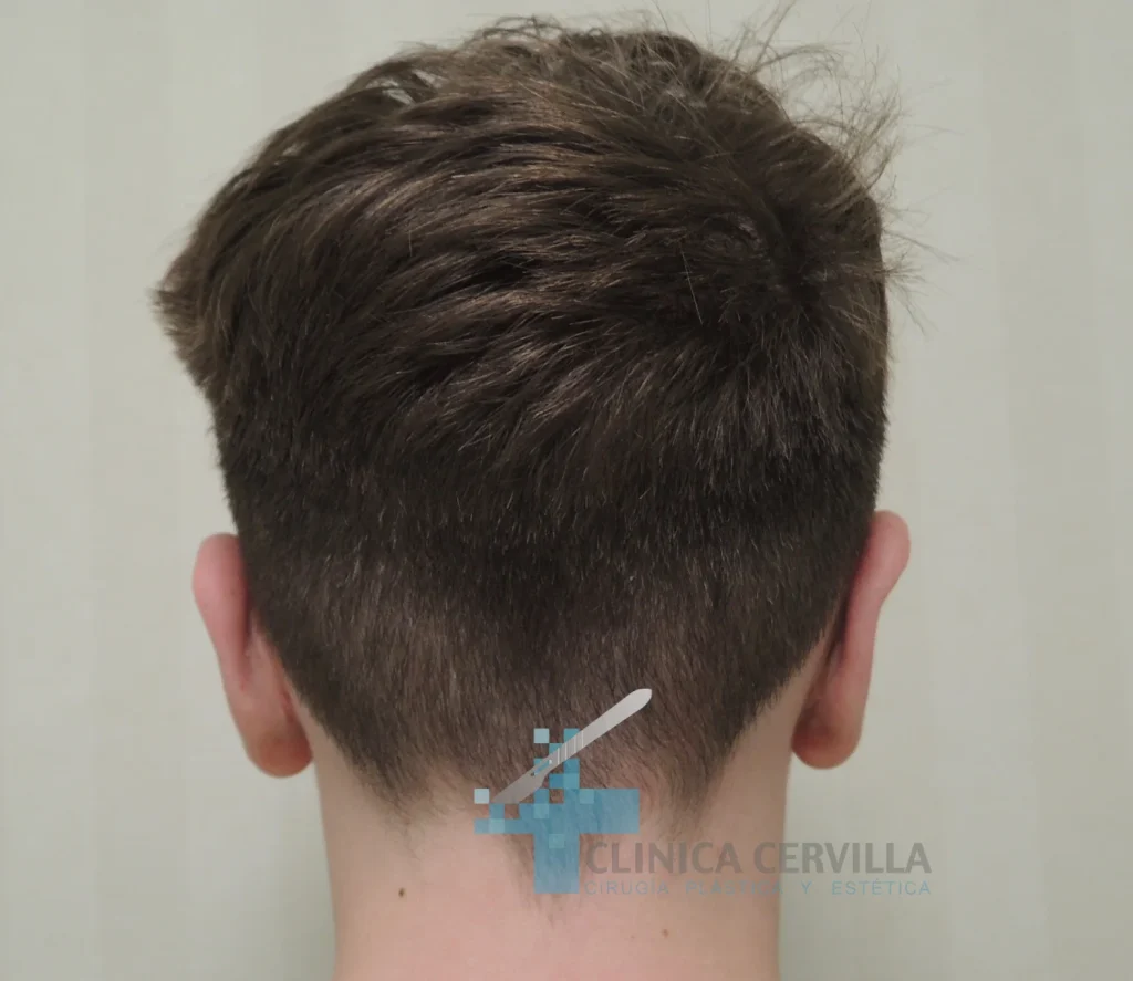 otoplastia sevilla - despues 1
