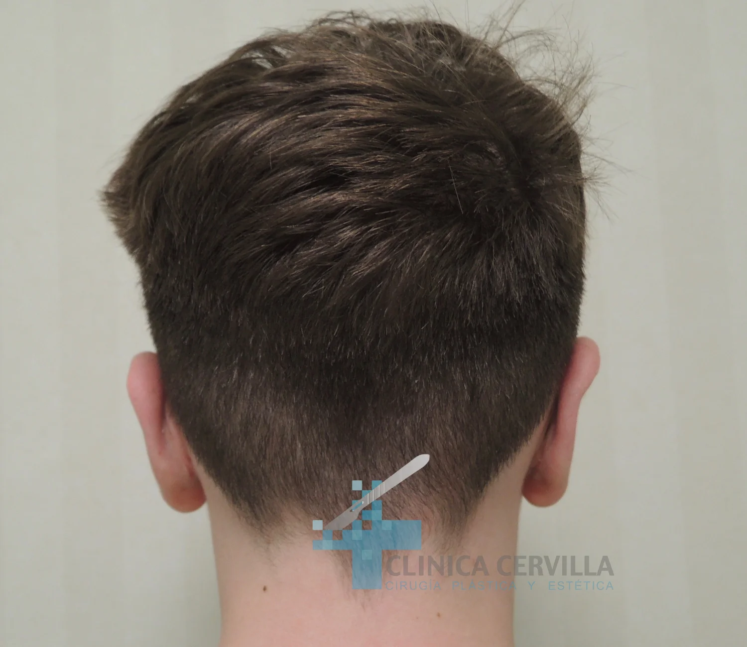otoplastia sevilla - despues 1