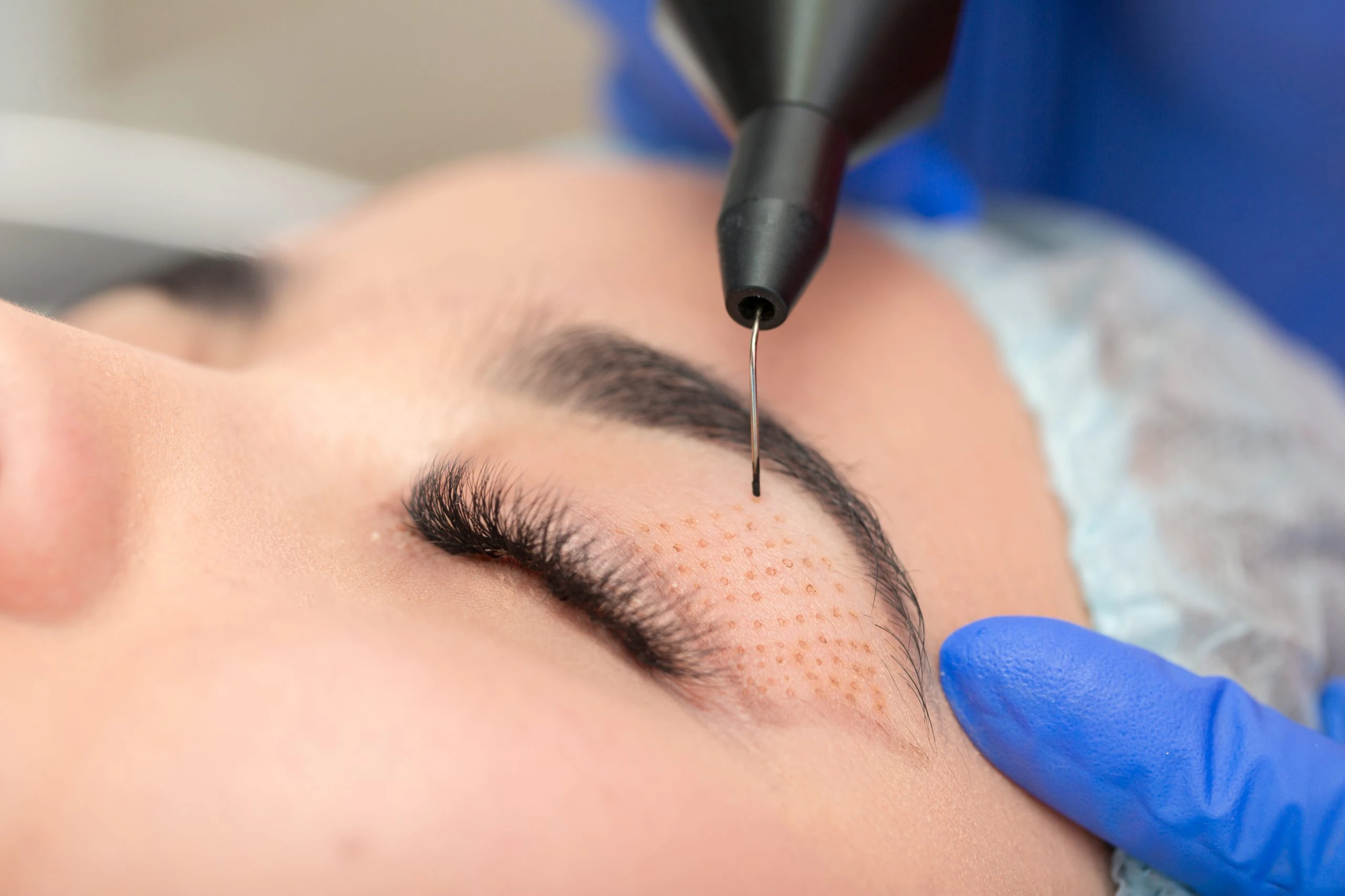 personas acuden a tratamientos de blefaroplastia