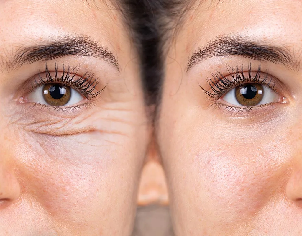 post operatorio blefaroplastia inferior