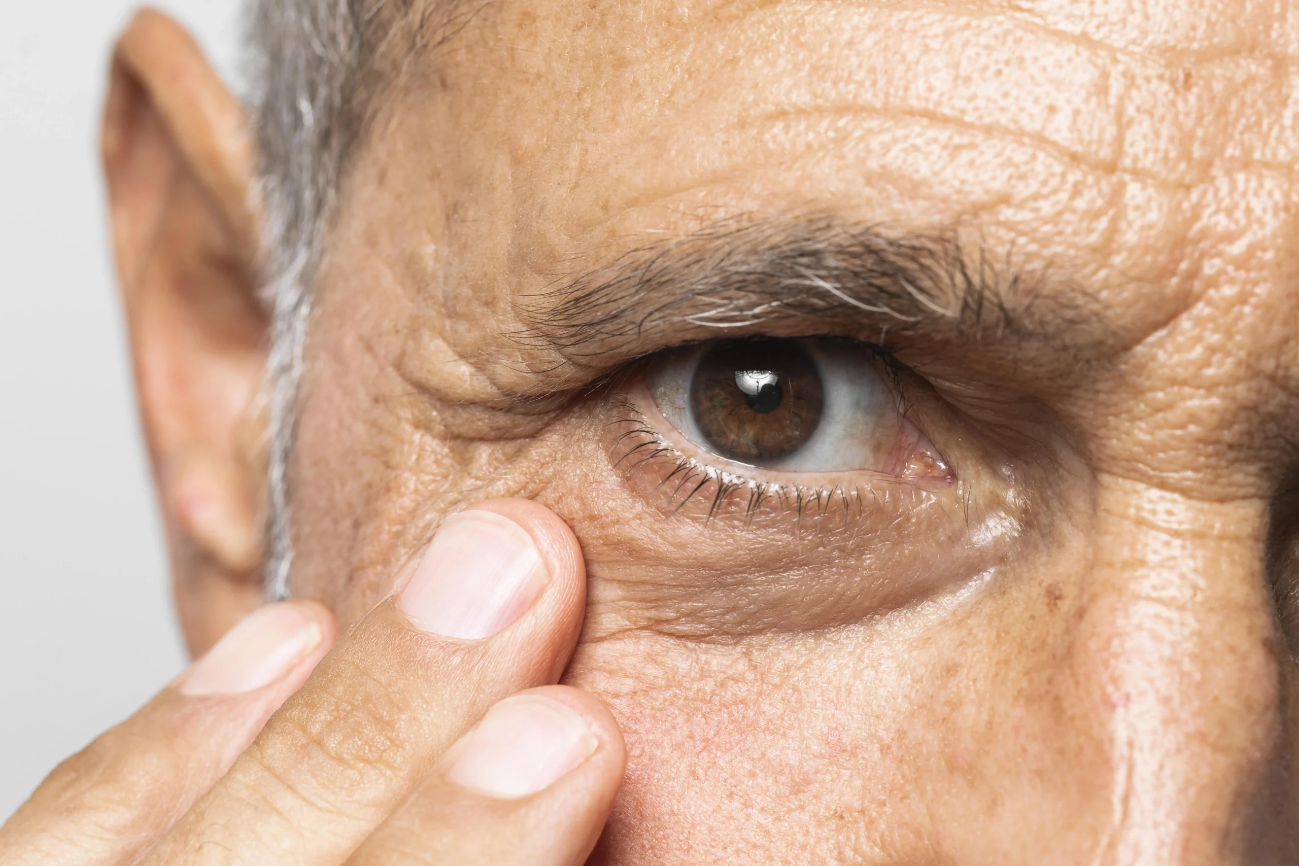 que-es-la-blefaroplastia-funcional
